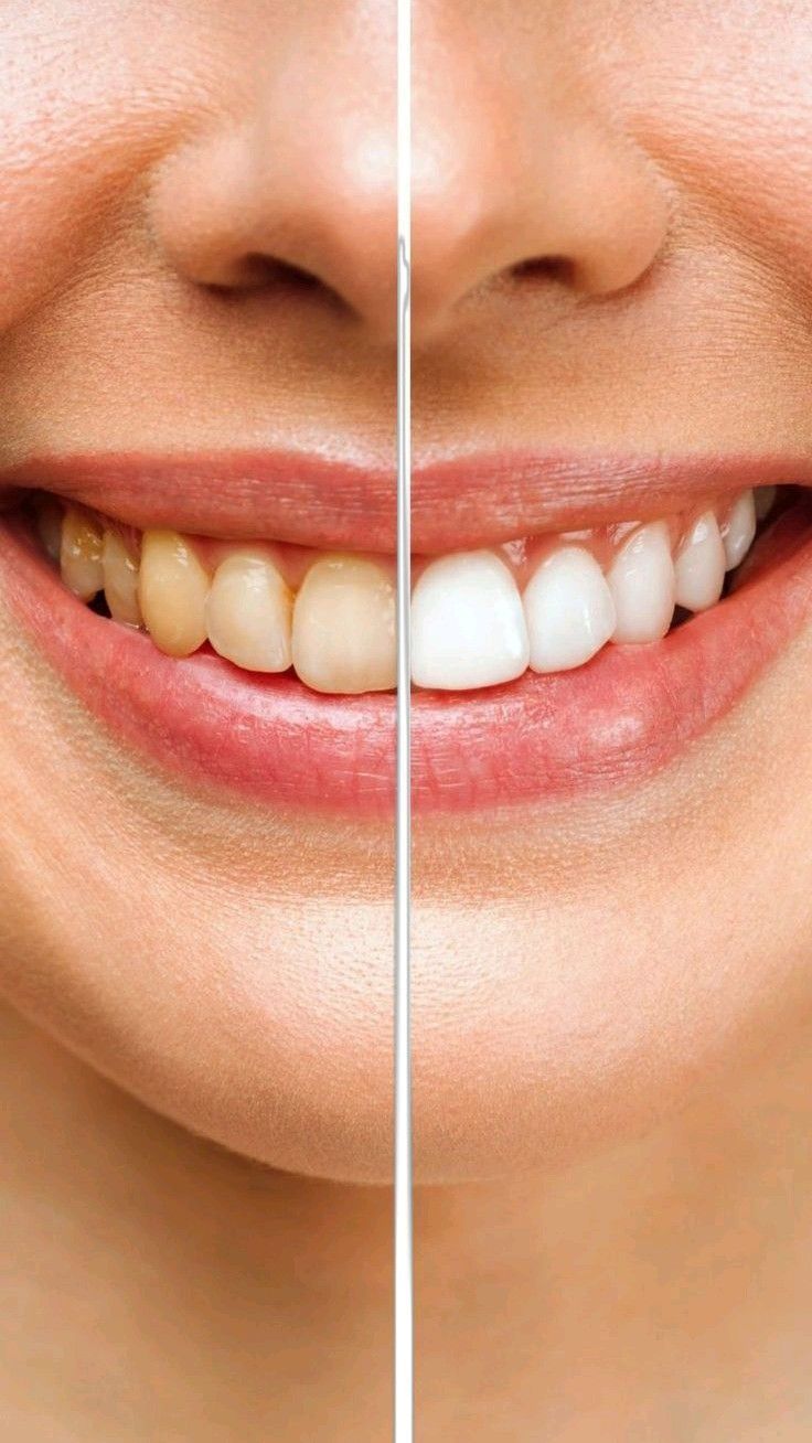 White teeth in just 20 days